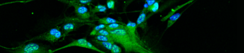 Glioblastoma: a mechanism that helps tumor cells multiply discovered