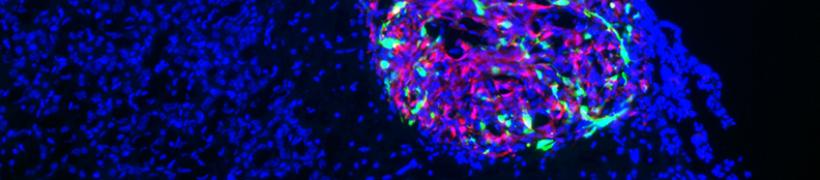 glioblastoma_graft_792X175.jpg